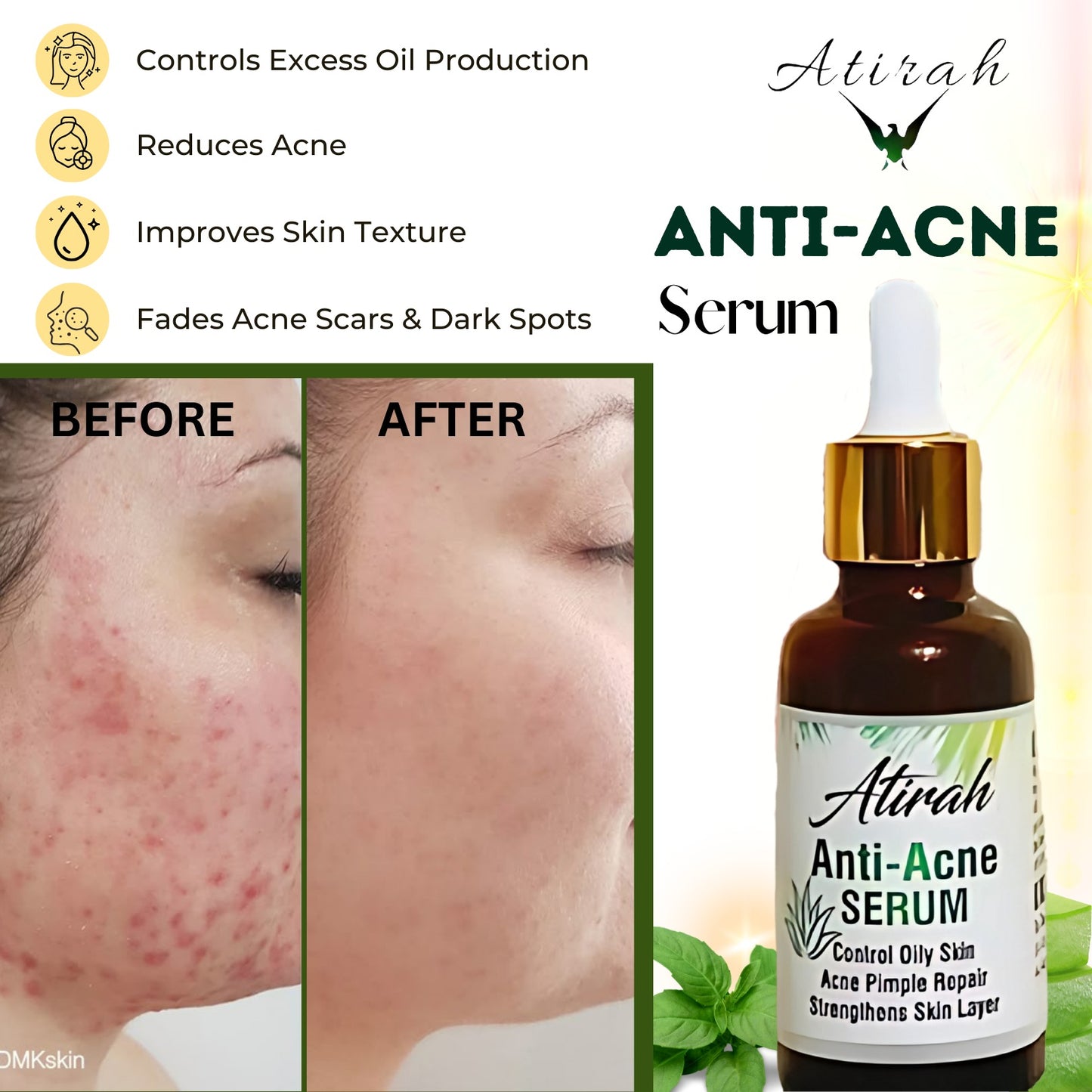 Atirah Anti-Acne Serum – Vitamin C + E (30ml)
